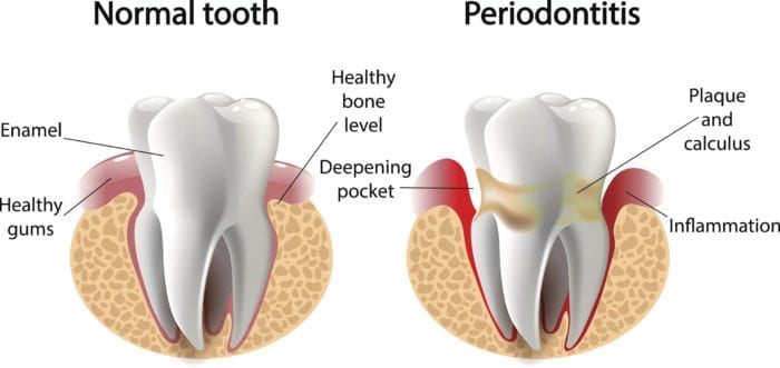 periodontist in asheville nc for gum disease