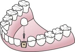 single implant asheville nc dentist