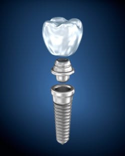 dental implants asheville nc