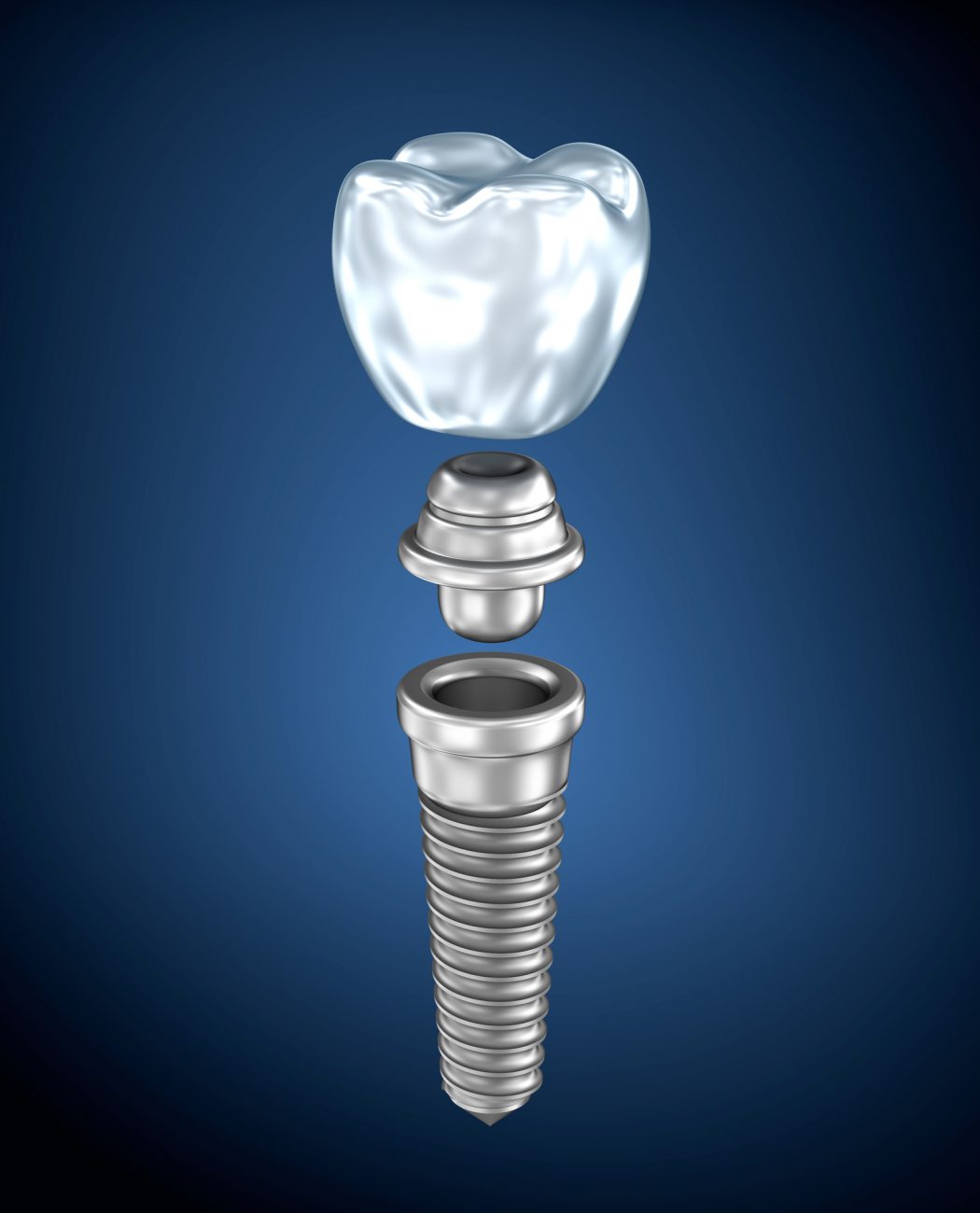 Dental Implants Asheville NC | Teeth Implants