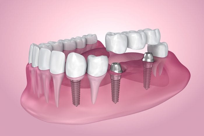 dental implants asheville nc