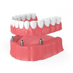 permanent dentures after gum disease